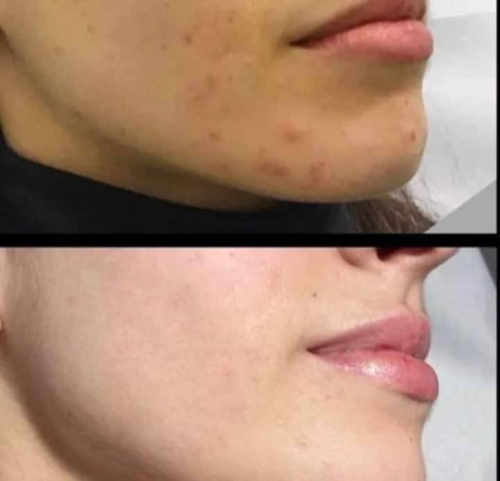 بنات عندي خبطه تبيض الوجه وتوخر النمش والكلف وتنعم البشره
وعندي خبطه تسمين الوجه وتبيض خال 3ايام ولي تحب تجي خاص ا***********
