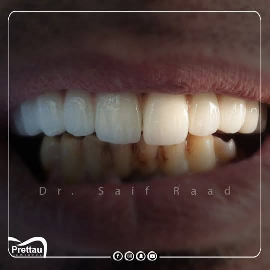 ✨ تريد ابتسامة هوليود ثابتة وبخصم 30%؟

هسه فرصتك حتى تحصل على ابتسامة ناعمة، مرتّبة، وتغليف زاركون ألماني مع تكنيك 7D اللي يطي شفافية وتفاصيل طبيعية تخبّل 😍

✔️ تغليفات ألمانية ثابتة
✔️ ضمان التركيبات 

💬✨مع عياده الرواسي لطب وتجميل الاسنان 
ابْتِسَاَمَتِگِ يمنااا غيررر

🧑‍🔬الدكتور سيف رعد /خبره اكثر م̷ـــِْن عشر سنوات في مجال طب وتجميل الاسنان 

📍 الحريه – الدولعي – داخل سوق الدولعي – ثاني فرع ع اليمين 
📞 ***********
