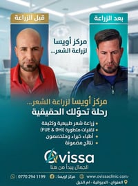 زراعة شعر • نتائج طبيعية • ميسان العمارة