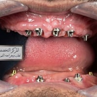 زراعة أسنان • الديوانية • حجز مواعيد