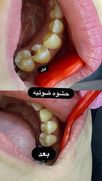 نارس • طب وتجميل الاسنان • الحصوه