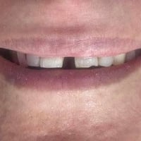 تم اعادة الابتسامة لمراجعتنا العزيزة باغلاق فراغات الاسنان بتغليفات ال...