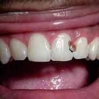 الي عنده تسوس مثل هيج ( بدون الم ) ويحب يعالجه مجانًا  ويكون متواجد با...