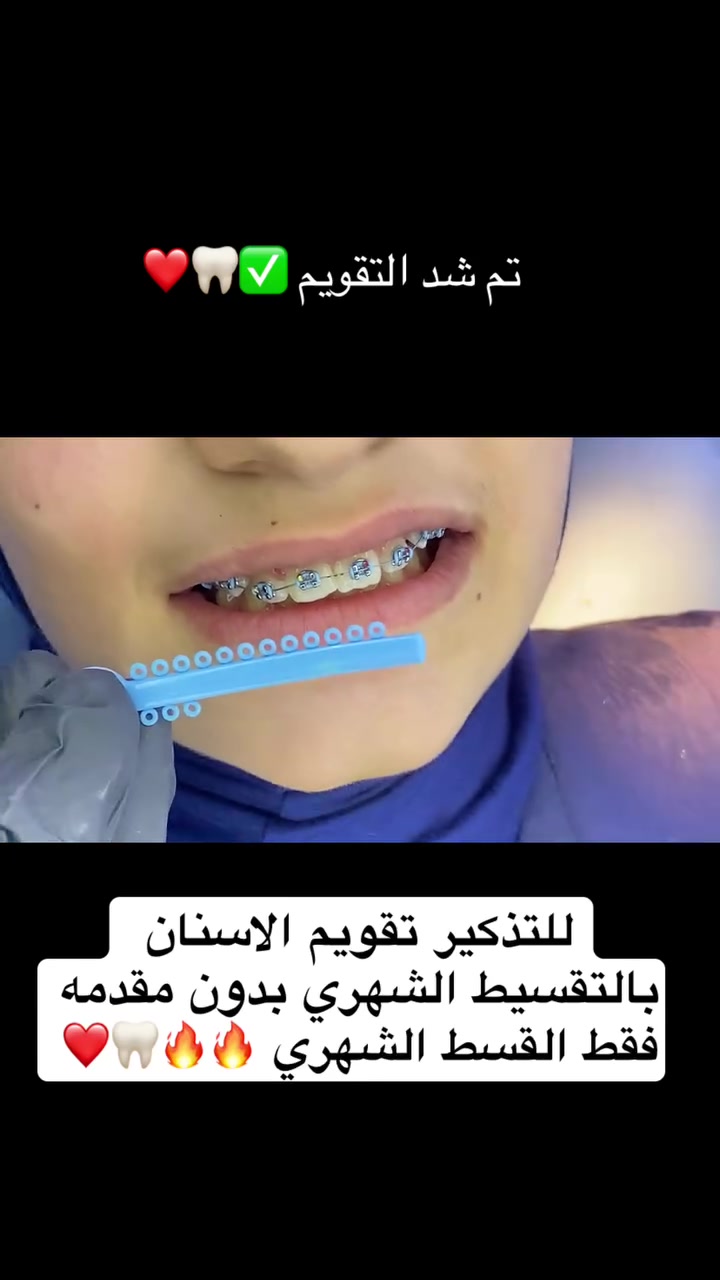 ⛔️تقويم الاسنان بالتقسيط الشهري بدون مقدمه فقط القسط الشهري ✅❤️
📍حله/ حي الامام/ مقابل كرار ابو الكص 
*********** واتساب
