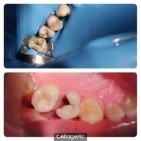 حشوة جذر • إعادة بناء سن • مسيب