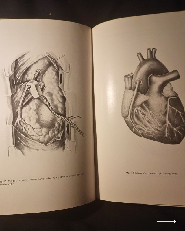 "أطلس جراحي طبي نادر وفخم من روائع الطب السوفيتي الأكاديمي! "
🚩
🫁
🩺
💚
📘
(Atlas of Thoracic Surgery - Volume Two)
المحرر: الأكاديمي بوريس ف. بيتروفسكي (Academician Boris V. Petrovsky).
⚜️
📚
🚩
☭
✨
عن هذه النسخة التراثية:
سنة الطبع: 1979م (طبعة أصلية قديمة ونادرة صادرة عن دور النشر العلمية السوفيتية المترجمة للإنجليزية).
الحالة: ممتازة
✅
⚜️
الموضوع:
أطلس جراحي موسوعي وفخم يتناول جراحة الصدر والأوعية الدموية الكبرى والقلب والرئتين بالتفصيل التشريحي والعملياتي الدقيق، يضم مساهمات كبار علماء الجراحة في الاتحاد السوفيتي السابق، يهم جداً أطباء جراحة الصدر والقلب، طلاب كليات الطب والصيدلة، وهواة اقتناء المراجع الطبية التراثية الأجنبية النادرة.
🔹
السعر: 35 د. ع.
📜
للحجز
🔻
:
البوت:
@PH_900bot
أو واتساب: ***********
