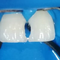 حشوات اسنان اماميه • عازل مطاطي • مقابل مستشفى القياره