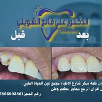 حشوة جذر • حشوات ضوئية • قلعة سكر