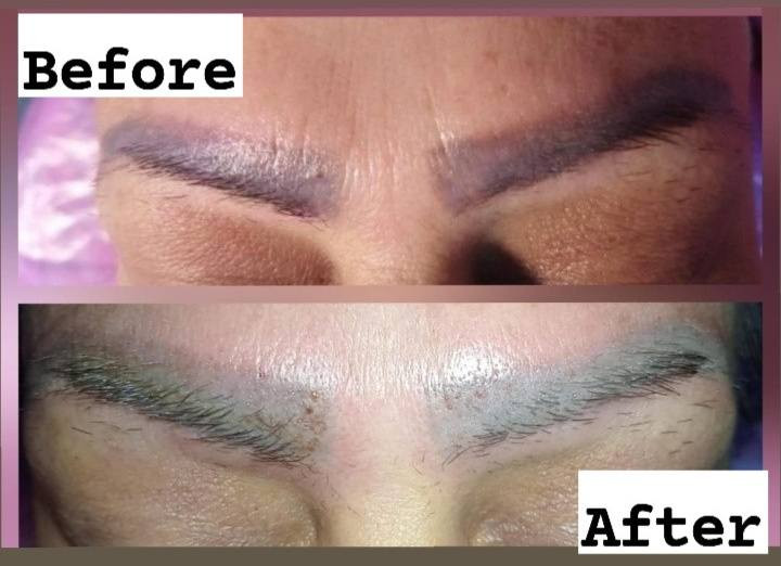 جلسة ازالة بالفيريموفل PhiRemoval المادة الوحيدة يلي بتشيل التاتو بعدد جلسات اقل باستخدام مواد آمنة بأفضل الطرق عالمياً .. بيتم ازالة التاتو بطريقة آمنة على الجلد وعلى الحاجب وعلى شعر الحاجب عن طريق مادة "الفيريموفل PhiRemoval" يلي بتشتغل على سحب الحبر من عمق الجلد الى سطح الجلد آمنة جدا" على البشرة و تحفز انتاج الكولاجين و اعادة انبات الشعر بمنطقة الحاجب🌸
📞للحجز تواصل مسنجر او واتسآب***********📱
