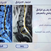 انزلاق غضروفي قطني • جرح ٢سم • استشفاء سريع