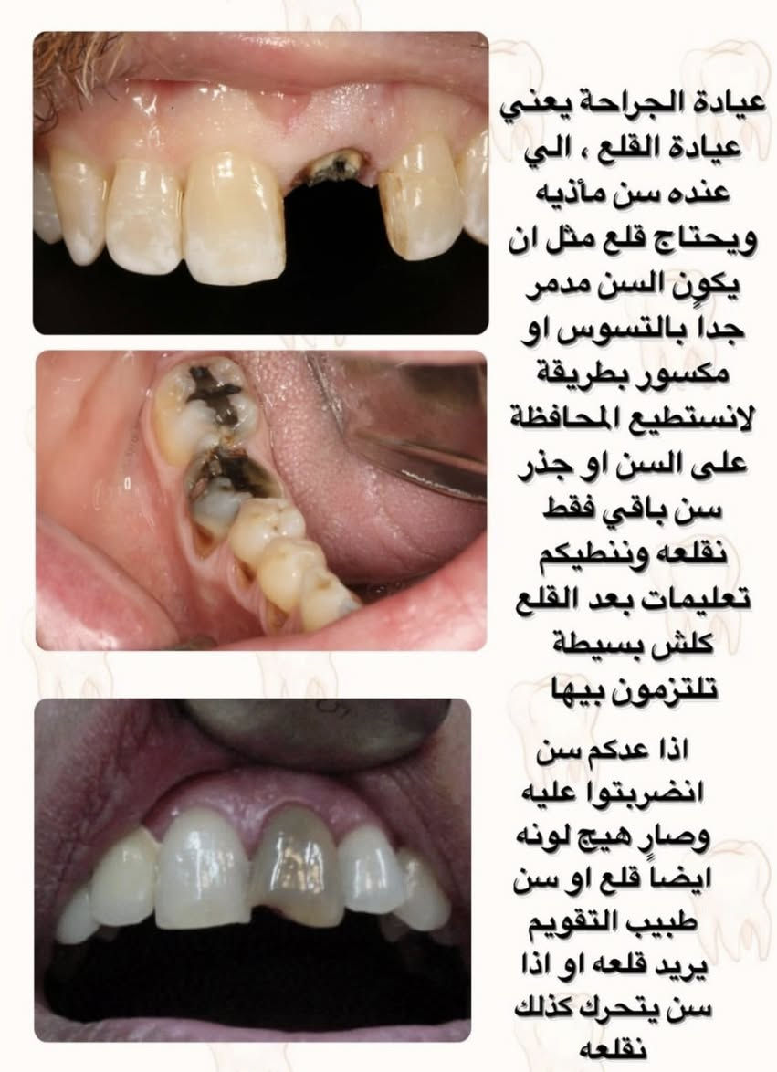 رجعنالكم بعروضنا المجانية الي ما تخلص ❤️‍🔥❤️‍🔥🔥🔥🔥
حشوات تجميلية
علاجات الاسنان للاطفال
حشوات جذور
قلع الاسنان التالفة
تنضيف التكلسات العنيدة 
طقم متحرك كامل
طقم متحرك جزئي
تعويضات فكية ثابتة
علاجات الاسنان للاطفال
كل هذذااا مجانننيييي 
سارعوا بالحجز يجماعة ولا تفوتون كل هاي العروض
الشغل يكون تحت ايد افضل الدكاترة المختصين 🔥🔥🔥🔥🔥🔥

للحجز على الماسنجر او الواتساب

***********

عيادات جامعة المنارة
