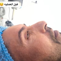 تجميل أنف • إصلاح انحراف • الشطرة