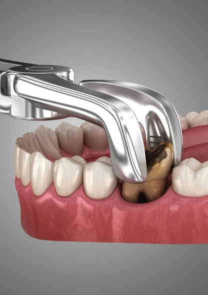 🔴 اعلان علاج مجاني... 

سلام عليكم.... وياكم دكتور محمد طب اسنان مرحله رابعه جامعه المناره... الي عنده اسنان تالفه او جذور متبقيه ويريد يقلعهم يتواصل وياي على الرقم *********** واتساب علما انو دكتورات بنات موجودات إذا اهلك او اهلج هم حابين يقلعون والأطفال أيضا هم مشمولين إذا ابنك صغير ويحتاج قلع... ويتم العلاج مجانا اكيد وبأحدث الأدوات المعقمه وتحت اشراف دكاتره اختصاص...المكان جامعه المناره مجاور مستشفى الصدر التعليمي وذالك في يوم السبت ( غدا) الساعه 12 ظهرا

طيب هسه تكول اني من اقلع شنو استفاد خوب ابقيهن بحلكي يا دكتور !!

هسه اجاوبك شوف اذا تبقي الإسنان التالفه او الجذور بدون ما تقلعهم ف اولا رح تسببلك رائحه كريهة بالفم ومهما حاولت انو تزيلهة بغسول الفم او العلج ما رح تروح وثانيا رح تسويلك التهابات باللثه بس ممكن انت هسه ما تحس بيهة بس رح تشوفهة مستقبلا وثالثا رح تسويلك ذوبان بالعظم الي حول السن ف بتالي مستقبلا إذا ردت تسوي طقم او جسر ما رح يرهم عليك ورابعا رح يأثر ع الإسنان المجاوره وممكن ابعض الحالات يسويلك صداع اي الم بالرأس.

للتواصل *********** واتساب
