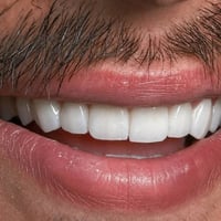 حشوات جذور • تغليف زيركون • ميسان الماجدية