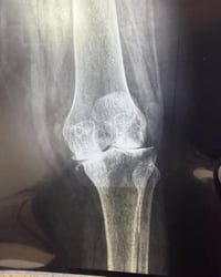 حالة مرضية مؤثرة… عندما يكون الألم رسالة إنذار  مريضة بعمر 30 سنة وصلت...