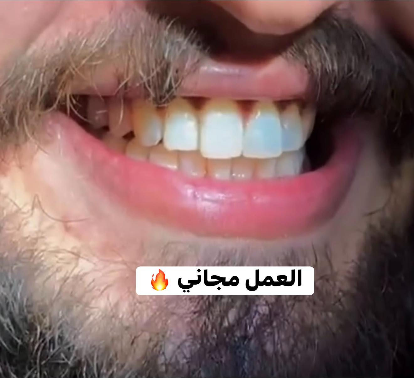 السلام عليكم
الي عنده تكلسات نفس الصوره ⬇️
يتواصل وياي باجر اخر عياده تنظيف اسنان مجانيه 
للحجز 
***********واتساب
