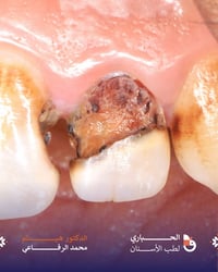إعادة تأهيل سن • تغليفات صحية • المسيب