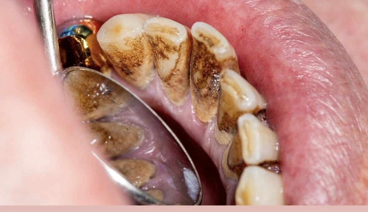 رجعنالكم بعروضنا المجانية لشهر رمضان المبارك  ❤️‍🔥❤️‍🔥🔥🔥🔥
ملاحظة: هذي العروض فقط خلال شهر رمضان وبعدها تنتهي 
حشوات تجميلية
علاجات الاسنان للاطفال
حشوات جذور
قلع الاسنان التالفة
تنضيف التكلسات العنيدة 
طقم متحرك كامل
طقم متحرك جزئي
تعويضات فكية ثابتة
علاجات الاسنان للاطفال
كل هذذااا مجانننيييي 
سارعوا بالحجز يجماعة ولا تفوتون كل هاي العروض
الشغل يكون تحت ايد افضل الدكاترة المختصين 🔥🔥🔥🔥🔥🔥

للحجز على الماسنجر او الواتساب

***********

عيادات جامعة المنارة
