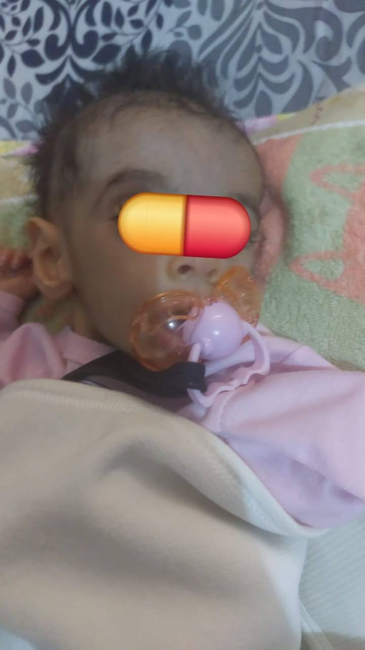 تشخيص حالة نادرة جدا لاسهال ولادي مزمن 🧬
اقل من ٤٠ حاله فقط حول العالم🌍

استقبلنا طفلة تعاني من الاشهر الاولى بعمرها من:
🔹 إسهال شديد ومستمر
🔹 تقيؤ متكرر
🔹 ضعف شديد في النمو
🔹 نقص حاد في بروتين الدم أدى إلى تورم الجسم بالكامل، مع تجمع السوائل في البطن والصدر وحول القلب.
دخلت المستشفى 11 مرة، واحتاجت إلى التغذية الوريدية (TPN) لعدة أشهر، ولم تتحسن رغم تجربة أنواع متعددة من الحليب العلاجي.
بعد إجراء الفحوصات الوراثية، تم اكتشاف طفرة نادرة جدا في جين DGAT1، وهو مرض وراثي نادر جدًا يسبب عدم قدرة الأمعاء على التعامل مع الدهون بشكل طبيعي.
✨ المفاجأة كانت أن الحالة تحسنت بشكل واضح بعد: ✅ إيقاف الحليب. ✅ اتباع حمية قليلة الدهون. ✅ استخدام زيت MCT مع الفيتامينات المناسبة.
اليوم أصبحت تتبرز مرة إلى مرتين يوميًا بعد أن كانت تعاني من 7–10 مرات يوميًا، وتوقفت الحاجة إلى التغذية الوريدية.
📌 الرسالة المهمة: إذا كان الطفل يعاني من:
إسهال مزمن منذ الأشهر الأولى من العمر.
ضعف شديد في النمو.
نقص بروتين الدم أو تورم الجسم.
عدم الاستجابة لأنواع الحليب العلاجية.
فقد يكون السبب مرضًا وراثيًا نادرًا، والتشخيص المبكر قد يغير حياة الطفل بشكل كامل. 
 د. علي رعد بهلول
استشاري طب الأطفال وأمراض الجهاز الهضمي والكبد ومناظير الأطفال

📞 بغداد- ساحة بيروت ***********
بابل- القرية العصرية ***********
#إسهال_مزمن #أمراض_وراثية #DGAT1 #فشل_النمو #طب_الأطفال #أمراض_الجهاز_الهضمي_للأطفال #ProteinLosingEnteropathy #TPN #بغداد #بابل
