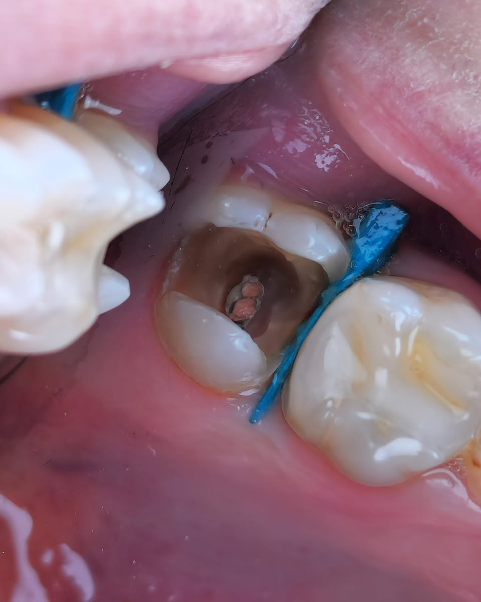 استبدال حشوة بلاتين قديمة بحشوة تجميلية بيضاء ✨
لوحظ وجود تغيّر بلون السن وتسوس مخفي تحت الحشوة المعدنية،
تمت إزالة الحشوة بالكامل وتنظيف التسوس بدقة،
واستبدالها بحشوة بيضاء تجميلية تعيد للسن لونه الطبيعي وقوته 💎
🔹 جلسة واحدة
🔹 بدون ألم
🔹 نتيجة طبيعية
للحجز والأستفسار راسلونا 📩
*********** 🟢📞 واتساب . 
#اسنان #طب_الاسنان #عيادة_اسنان #تجميل_الاسنان #حشوات  
Tokuyama Iraq
