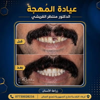 زراعة سن أمامي • عيادة المُهجة • كربلاء المقدسة