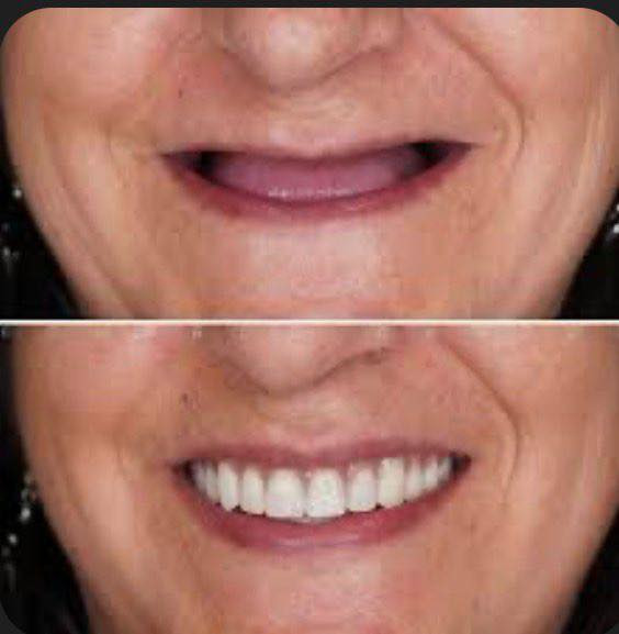 يوجد تعويض الاسنان المفقودة بشكل كامل او جزئي بطقم متحرك و بكفاءة عالية تحت اشراف اطباء مختصين 
في كلية طب الاسنان جامعة البصرة 
العنوان / الزبير مقابل جسر الخطوة 
☎️ للاستفسار و الحجز التواصل على الوتساب على الرقم ***********
ملاحظة / العلاج مجاني
