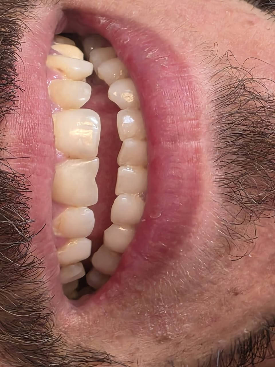 ✨ مو كل تغيير يحتاج برد ✨

قبل وبعد لمراجعنا الكرام😍
ابتسامة أجمل، لون أنصع، ومظهر طبيعي يحافظ على أسنانك ويمنحك طله  اجمل
عيادة دكتورة الدكتورة هند الحسيني 
***********
النواب/تقاطع الزهور/شارع المهداوي /مقابل عيادة النبأ

#ابتسامة_بدون_برد
#هوليود_سمايل
#تجميل_الاسنان
#اسنان_بغداد
#قبل_وبعد
