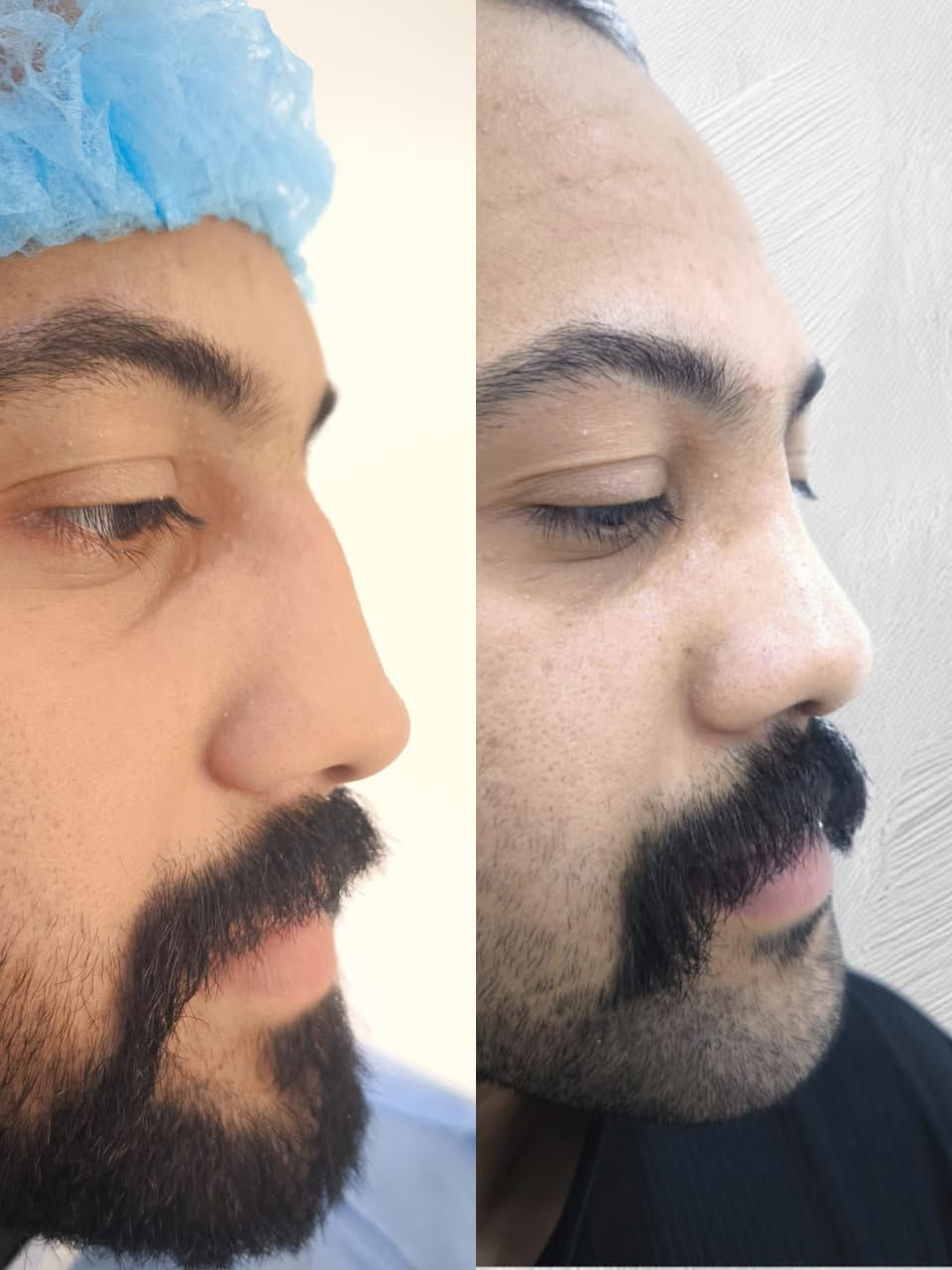 👃 تجميل الأنف وإصلاح الانحراف.. جمال طبيعي وتنفس مريح! ✨
​في مركز الشرق الأوسط، نؤمن أن الأنف الجميل هو الأنف الذي يمنحك الثقة والراحة في آن واحد. استعد الآن للحصول على النتائج التي طالما حلمت بها تحت إشراف  الدكتور محمود أحمد.
​✅ ما الذي يميزنا؟
​إصلاح انحراف الحاجز الأنفي: نخلصك من مشاكل التنفس ونعالج الانحراف الشديد بلمسة فنية وطبية دقيقة.
​تجميل المظهر الخارجي: تنسيق شكل الأنف بما يتناسب مع تفاصيل وجهك لضمان إطلالة طبيعية.
​راحة وأمان: العملية تُجرى تحت التخدير الموضعي، لتجنب مخاطر التخدير العام وضمان فترة نقاهة سريعة.
​عرض خاص: السعر الآن 600,000 دينار عراقي فقط!
​📸 شاهد الفرق في الصور:
تظهر النتائج بوضوح كيف تم تعديل الانحراف الخارجي وإصلاح الممرات الهوائية، مما يمنح المريض مظهراً متناسقاً وقدرة أفضل على التنفس.
​📍 العنوان: مركز الشرق الأوسط - الشطرة - حي المعلمين
📲 للحجز والاستفسار‏078-132-88144‏
​#مركز_الشرق_الأوسط #الدكتور_محمود_أحمد #تجميل_الأنف #انحراف_الحاجز_الأنفي #تجميل_الشطرة #عمليات_تجميل #العراق #ذي_قار #تخدير_موضعي #جمال_وثقة


**إذا كنت صاحب هذا الإعلان وتريد حذفه لأي سبب، رجاءا أرسل رسالة إلى الدعم الفني**