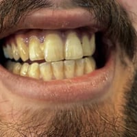 الي عنده تكلسات نفس الصوره ⬇️ يتواصل وياي باجر اخر عياده تنظيف اسنان م...