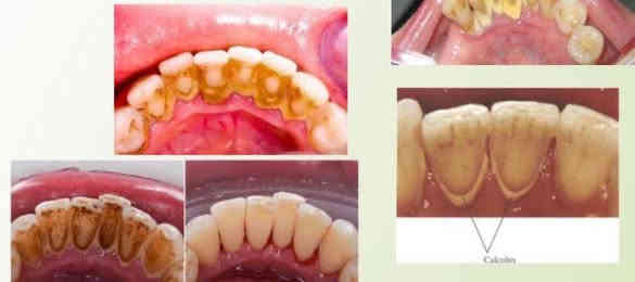 🆓 تنظيف الاسنان مجانا 🆓 
في عيادات نموذجية وتحت اشراف اطباء اختصاص

ابتسامتك تستحق العناية! نظف أسنانك اليوم قبل أن يذكّرك الألم غدًا.

ازالة التكلسات المتجمعة على الاسنان تعد من اهم الاجراءات للحفاظ على سلامة الاسنان من التسوسات والتهاب اللثة 

ماهي اضرار بقاء التكلسات على الاسنان؟ 

1. التهاب اللثة (Gingivitis)
 •التكلسات تحتوي على بكتيريا تسبب التهاب اللثة

2. التهاب دواعم الأسنان (Periodontitis)
 •إذا لم يُزال التكلس، ينتشر الالتهاب إلى العظام والأنسجة الداعمة

3. تسوس الأسنان (Dental Caries)
 •التكلس يحجز البكتيريا والحمض على سطح السن وبالتالي يزيد من تسوس الأسنان

4. رائحة الفم الكريهة (Halitosis)
 •البكتيريا الموجودة في التكلس تنتج روائح كريهة

5. تغيير في شكل الأسنان واصفرارها
 •التكلس يترك طبقة صلبة صفراء أو بنية على الأسنان ويالتالي يقلل من جمال الابتسامة

العنوان/كربلاء/عيادات جامعة كربلاء (حي الموظفين)قرب مستشفى الولادة 
للاستفسار التواصل على الخاص
او رقم الواتساب / ***********
