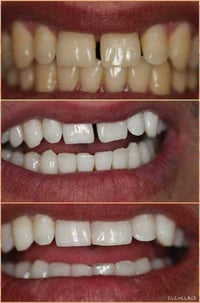 تبيض بالليزر • حشوات تجميلية • خانقين