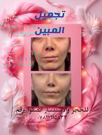 تغيير شامل  للوجه مع حفظ الملامح الاصلية واعادة التقارن لجنابيه الوجه ...