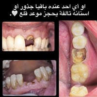 علاج مجاناً مجاناً اي احد يحتاج قلع يحجز موعد على واتساب 07502020981
