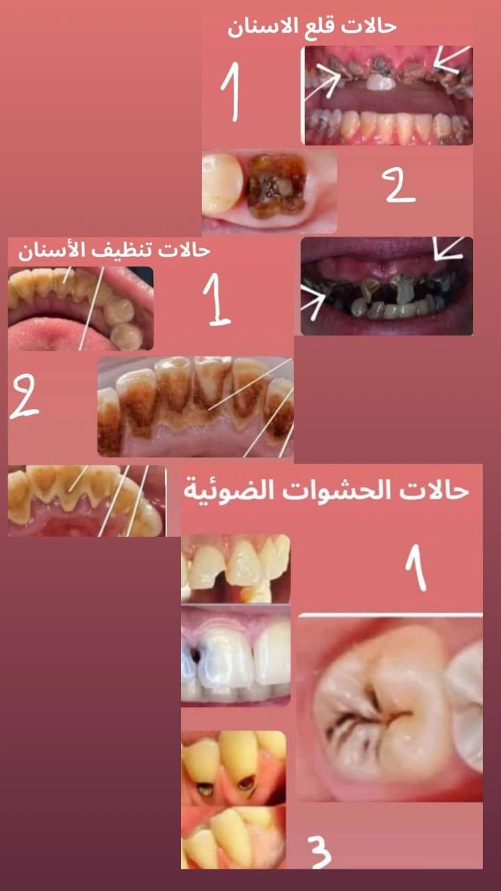 فحص  وتشخيص الأسنان بأستخدام الأشعة السينية X_ray  حشوات تجميلية  _قلع الأسنان  التالفة والجذور  _تنظيف الأسنان وازالة  التكلسات
نحرص على تقديم رعاية طبية دقيقة، بيئة آمنة، ونتائج موثوقة
✨ بإشراف مباشر من أطباء اختصاص في طب الأسنان
📞 للاستفسار والمراجعة يُرجى الحجز المسبق ***********
