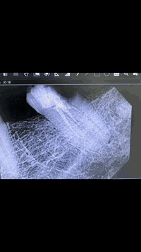 اعاده حشوه جذر باحدث الاجهزه بعد فشل الحشوه السابقه
انقاذ السن م̷ـــِْن القلع بحشوه جذر بطريقه متقنه وصحيحه
احجز موعدك اليوم وخلي ابتسامتك تحجي عنك بكل أناقة 😁✨
☎️ للحجز والاستفسار:
📞 ***********
📍 موقع العيادة:
📌 الدولعي داخل سوق الدولعي ثاني فرع ع اليمين
