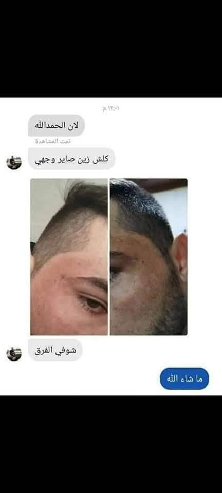 خلطه سن شاين♥♥الاصليه♥♥
معجزة التبيض الضمان حقيقي للمنتج
نتائج واضحة بعد 3 ايام من الاستعمال😲😲😲

 ((مع ابرة النضاره الملكيه)) 

🌹 فوائد الخلطه👇🏻👇🏻👇🏻
1-التبيض 7 درجات. 
2-ازالة التصبغات.
3-ازالة الكلف و النمش.
4-ازالة التجاعيد(ان وجدت).
5-ازالة هالات السوداء تحت العين.
6-تضيق المسامات.
7-ازالة حب الشباب و اثار الحب. 
8-امن للبشرة الحساسة و مناسب لجميع البشرات الدهنية و وجافه
للحجز والاستفسار واتساب رقم تلفون ***********
