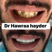 🔹 خصم 20–30٪ على تركيبات الزركون أو الإيماكس عند عمل 6 أسنان أو أكثر 🔹...