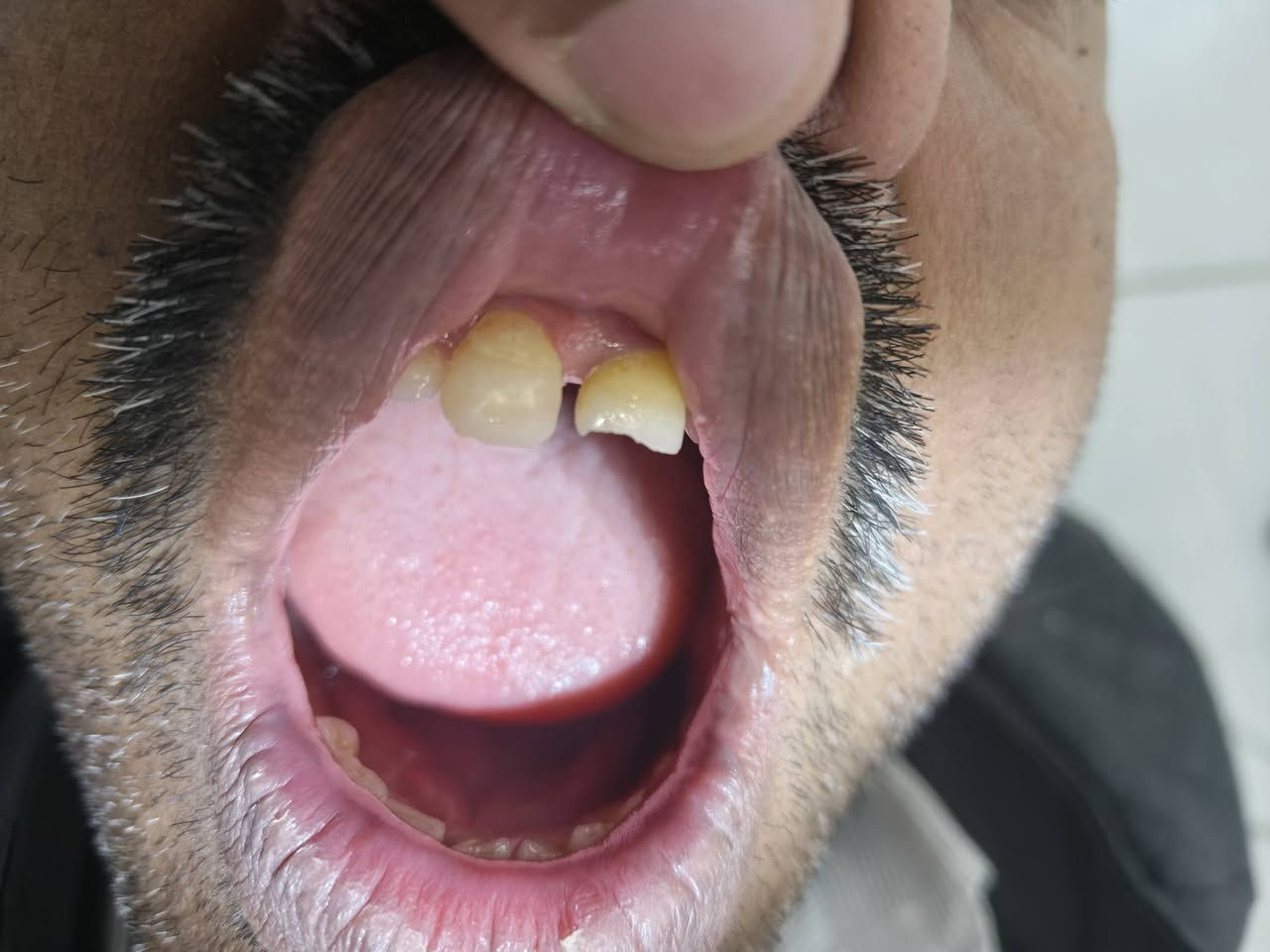 يتوفر علاج اسنان مجاني (حشوات ضوئية، تعويض اسنان مفقودة، قلع بقايا الجذور والاسنان التالفة، وتنظيف الاسنان، وحشوات الجذور)
العلاج يكون  مجاني بالكامل وتحت إشراف اطباء اخصائيين، جامعة البيان شارع مطار بغداد، 
للحجز و الاستفسار التواصل في الخاص او على الواتساب ***********
