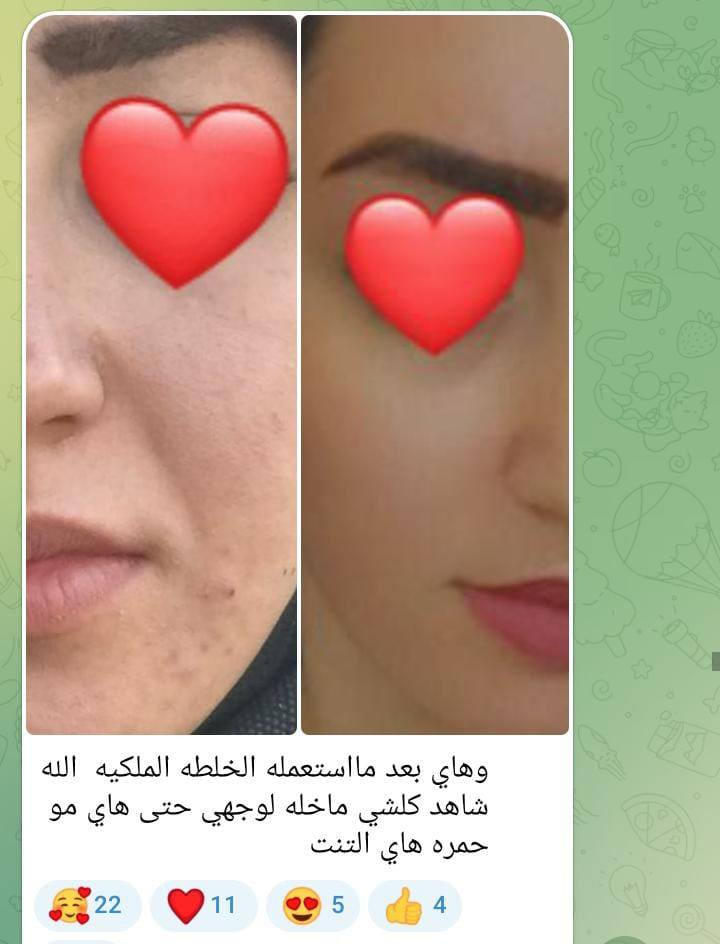 الخلطة الملكيه 😍 الااصليه
‏ღ  فعالة من اول  علبة خلال  ايام نتائج مبهرة
#بخلاصة_الصبار والكولاجين والفيتامينات من منتجات شركه فوريفر خاليه من المواد الكيميائيه  😍😻
1 تبيض وتوريد البشرة🙆
. 2 وأزالة الكلف.النمش.التجاعيد💆
. 3 واثار الحب وتساعد في التئام الحفر🤗
. 4 وتورد الوجة .تبدأ النتائج خلال 7 أيام فقط 🌹
. 5 ازالة التصبغات .✔
6 وازالة السواد حول العين ★👰
.7 تضيق المسامات😙
8 ازالة حب الشباب✔

طريقة الاستعمال تضع كمية مناسبة
 على الوجه وغسلها في الصباح
 
👑معجزة التبييض مع خلطة لينا بيوتي
الحل الامثل للنساء 👩والرجال👨
🔴لتبييض الوجه.
🔴علاج الكلف بالوجه وحب الشباب واثاره.
🔴ازالة التصبغات ،والهالات السوداء.
🔴عدم صفاء ونقاوة البشره.

 👌عدنه الحل💥:⏬⏬⏬
👑:  خلطه سحريه ✨ لتبييض الوجه خلال 3 أيام فقط🤔وبمفعول دائمي 🕛
 👑تغذي وترطب طبقات الجلد. وتزيل الكلف والنمش والتصبغات ☛وتوحد لون البشره 
 واايضا التخلص من حب الشباب واثاره .تبيبض البشره من 5الى 7 درجه
تتكون من مواد عشبيه🌿تناسب جميع انواع البشره 
نتائج دائميه ومضمونه💯

🦋🫀🦋🫀🦋🫀


**إذا كنت صاحب هذا الإعلان وتريد حذفه لأي سبب، رجاءا أرسل رسالة إلى الدعم الفني**