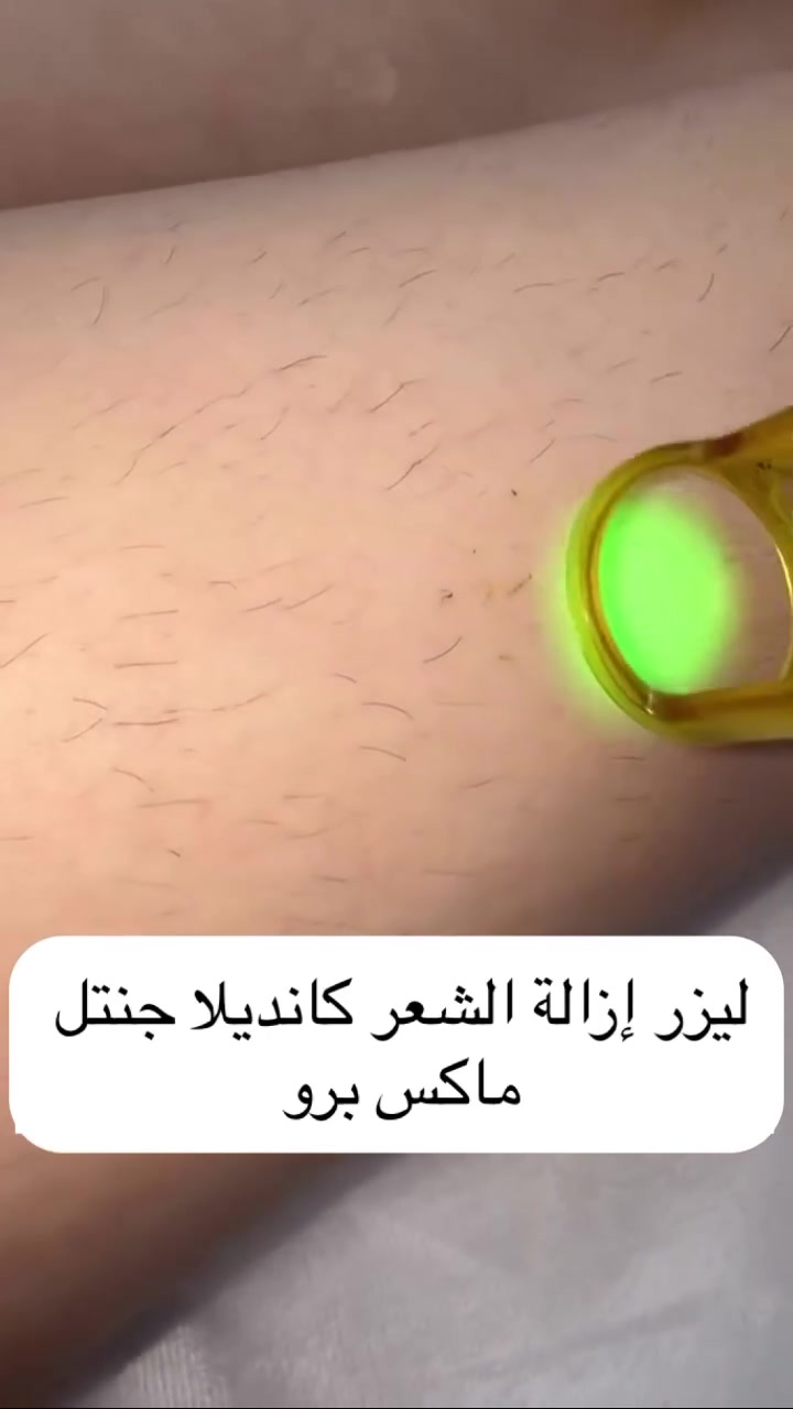 تم بحمد الله 
ومثل ماوعدتكم 
وصول الجوووكر 
الجهاز الي بدون الم 
الجوكر يعني يرهم على كل الاجهزة بدون تحفيز
يعني لو مسوية باي جهاز يرهم حتى لو واصلة ادامة 
الاكسندرايت يعني يرهم للبشرة البيضاء والسمراء حتى الافريقي 
4 جلسات او 5 يوصل ادامة 
نتائج فورية وبضمان 
من مجمع ماس الطبي 

هلو حبايبي هواية تسالون عالجهاز الجديد 
وصل وصل حبايبي 
جنتل مكس برو 2026
من المصنع الى مجمع ماس الطبي
نظام الكسندرايت اندياك 
 
يعمل بنظام التبريد بواسطة الزمر الخارجية وغاز النتروجين 
جميع انواع الشعر عدا الشعر الاشيب 
يسخدم حتى للبشرة الافريقية والاماكن العنيدة الصعب ازالة الشعر منهة 
للاسعار
وجه 20 
اندر 20 
بكيني 20 
3 مناطق ب50
نصف ايد 30 
نصف ساق 30 
ايد مع اندر 50 
ساق 50 
ساق مع بكيني 60
مني بدي 80 
فول بدي 100 
توتل بدي 125

كل 4 بيشنت ال5 مجاني 
العنوان المجمع الترفيهي @مجمع ماس الطبي 
مقابل مول بسماية 
للحجز والاستفسار ***********
 ا@إشارة
