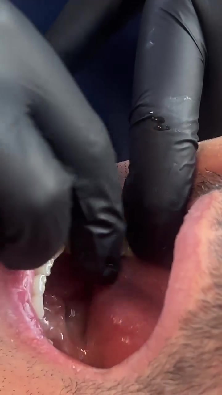 🦷 رجعنا القوة والجمالية للابتسامة من جديد!

تم بعون الله تعويض أربع أسنان خلفية مفقودة واستعادة وظيفة المضغ والشكل الطبيعي للفم بأحدث الطرق العلاجية ✨

بعد المعاينة الدقيقة ووضع الخطة العلاجية المناسبة، تم إنجاز الحالة بنتيجة مريحة وجمالية ممتازة، حتى يرجع المريض ياكل ويرتاح بثقة أكثر 💎

✅ تحسين المضغ والكلام
✅ استعادة الشكل الطبيعي للأسنان
✅ نتائج ثابتة وجمالية عالية
✅ مواد ذات جودة ومتانة ممتازة

📍 عيادة البيت الطبي
الدكتور علي حسين صادق أمين
📌 بغداد – المحمودية – حي الموظفين – مقابل التانكي
📞 للحجز والاستفسار: (***********

ابتسامتك تستاهل الأفضل 🤍
