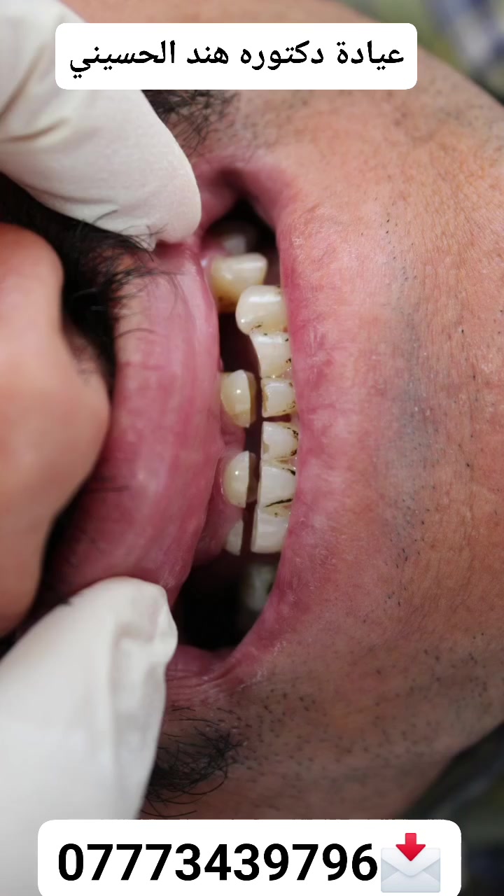 🦷 ابتسامة  بتصميم طبيعي، لون متناسق، ونتيجة تعزز الثقة بكل ابتسامة.
إذا كنت تبحث عن ابتسامة مرتبة وطبيعية تناسب ملامحك، فهذا هو الوقت المناسب.
زوروا عيادتنا
الامين الثانيه /النواب/شارع المهداوي مقابل عيادة النبأ

📩 للحجز والاستفسار راسلونا على ***********، والمواعيد محدودة.
