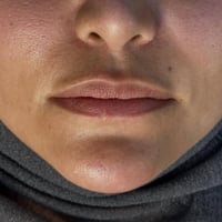 فيلر • تجميل