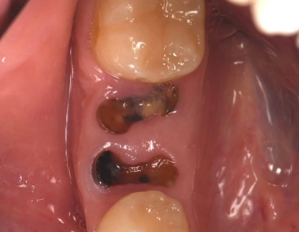 ❗️❗️
السلام عليكم ،،الي محتاج حشوات او تنظيف التكلسات او قلع اسنان او بقايا جذور او فاقد اسنان و يحب نسويله طقم يتواصل وياي  عالرقم ***********

علماً ان العلاج مجاني و بأشراف اطباء اختصاص❕

العنوان : عيادات جامعه الكفيل شارع الاسكان في النجف الاشرف

