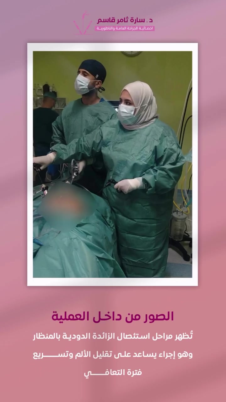 ألم بسيط بدأ بشكل مفاجئ…
لكن خلال ساعات تبيّن أنه التهاب حاد بالزائدة الدودية ⚠️

تم استئصال الزائدة الدودية بالمنظار بنجاح، والتدخل المبكر ساهم في تجنب المضاعفات وتسريع التعافي.

لأي استفسار 
راسلونا عبر الخاص 📲
او الاتصال عبر الرقم *********** ☎️
📌العنوان : الحرية - دور نواب الضباط - قرب مستشفى الشرق الاوسط

#الزائدة_الدودية #استئصال_الزائدة #جراحة_المنظار #جراحة_عامة #التهاب_الزائدة

