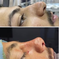 تجميل الانف • مستشفى منصور • عروة حمدان