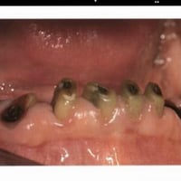 قلع اسنان • مجاناً • واتساب