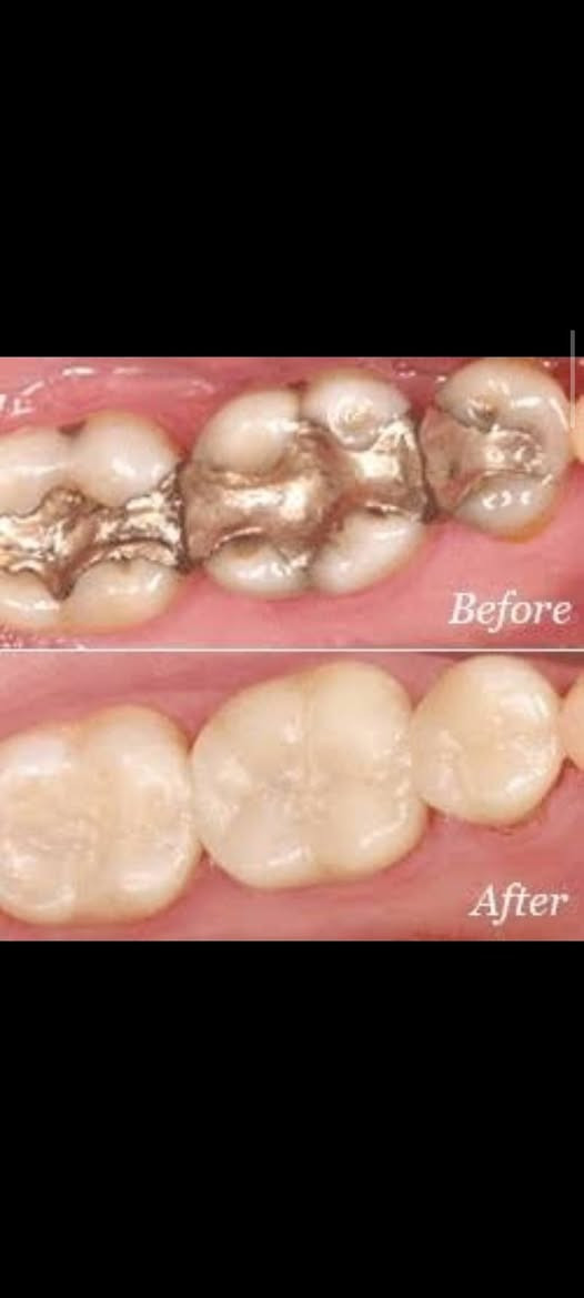 علاج مجاني
السلام عليكم ورحمة الله وبركاته للمرضى الاعزاء يتوفر لدينا :-

قلع سن.

 حشوة اعتيادية.

 تنظيف الاسنان من التكلسات.

تبديل حشوة قديمة بحشوة ضوئية.

طقم اسنان للفكين الاسفل و الاعلى.

مجاني في  عيادات جامعة النور التخصصية لطب الاسنان بإشراف الدكاترة المتخصصين في طب الاسنان الاستفسارات والأسئلة العامة الاتصال على الرقم التالي :
***********
الدكتور واثق عبدالله حسن 
ابتسم وانت مرتاح
