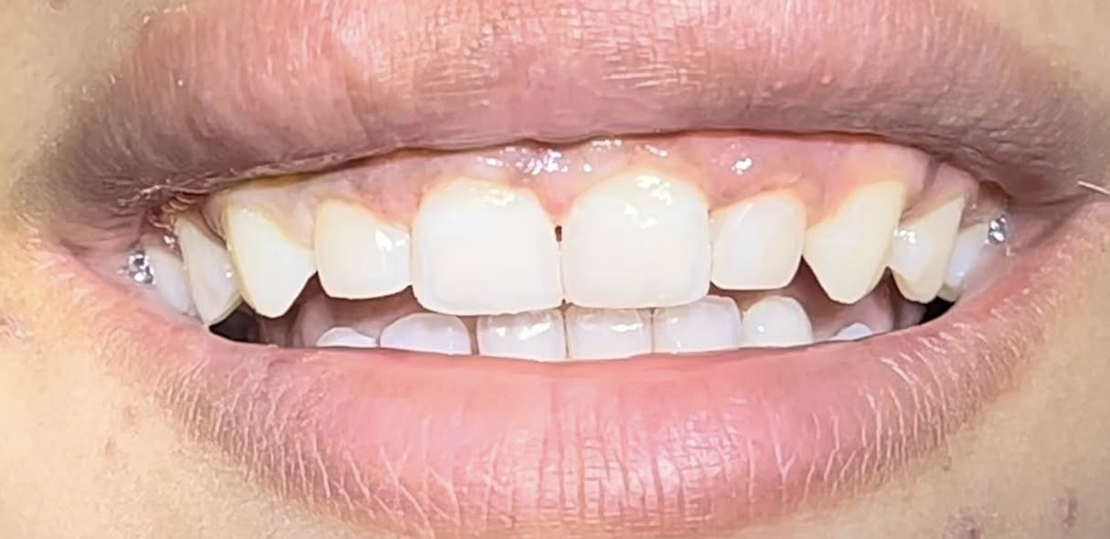 عيادة الطائي لطب الاسنان ♥️

حشوات تجميلية بأجمل صورة باستخدام مواد رصينة والوان الحشوات القريبة على الاسنان ✅

للحجز *********** واتس اب 
او على الرقم ***********  

عيادة الطائي لطب الاسنان

#سبعالبور
#التاجيات
#التاجي
#سبع_البور
