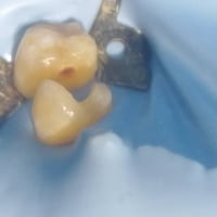 حشو تجميلي • الضواحك السفليه • د مهند الطحان